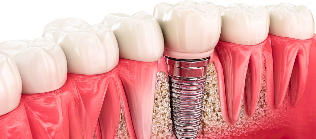 Implante dental vs puente